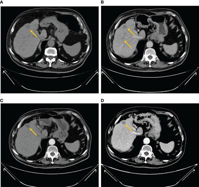 Patient-Derived Organoid Facilitating Personalized Medicine in Gastrointestinal Stromal Tumor With Liver Metastasis: A Case Report